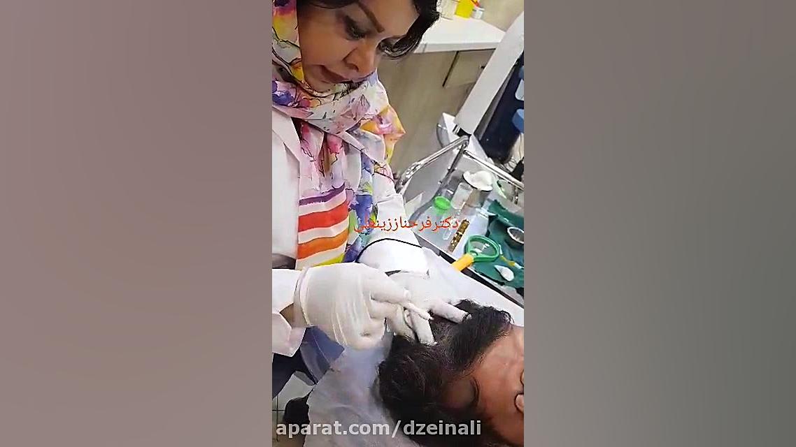 نمونه گیری بیوپسی پوست سر دکتر فرحناز زینعلی - متخصص پوست، مو، زیبایی زنجان