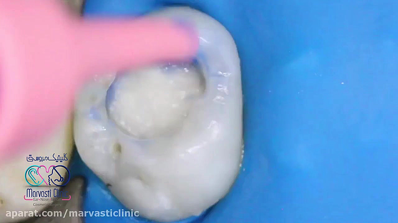 پر کردن دندان بیماری نوری آسیب ارثی