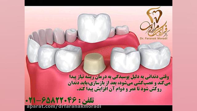 اهمیت روکش دندان بعد از عصب کشی انیدروز