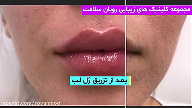 فرم دهی لب با تزریق ژل هیالونیک اسید با بیحسی و کاملا بدون درد درمان ریزش مو