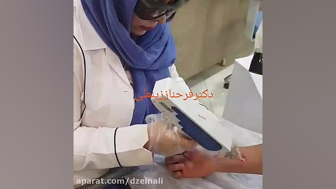 پاک کردن و رفع تاتو خالکوبی بدن توسط لیزر دکتر فرحناز زینعلی - متخصص پوست، مو، زیبایی زنجان