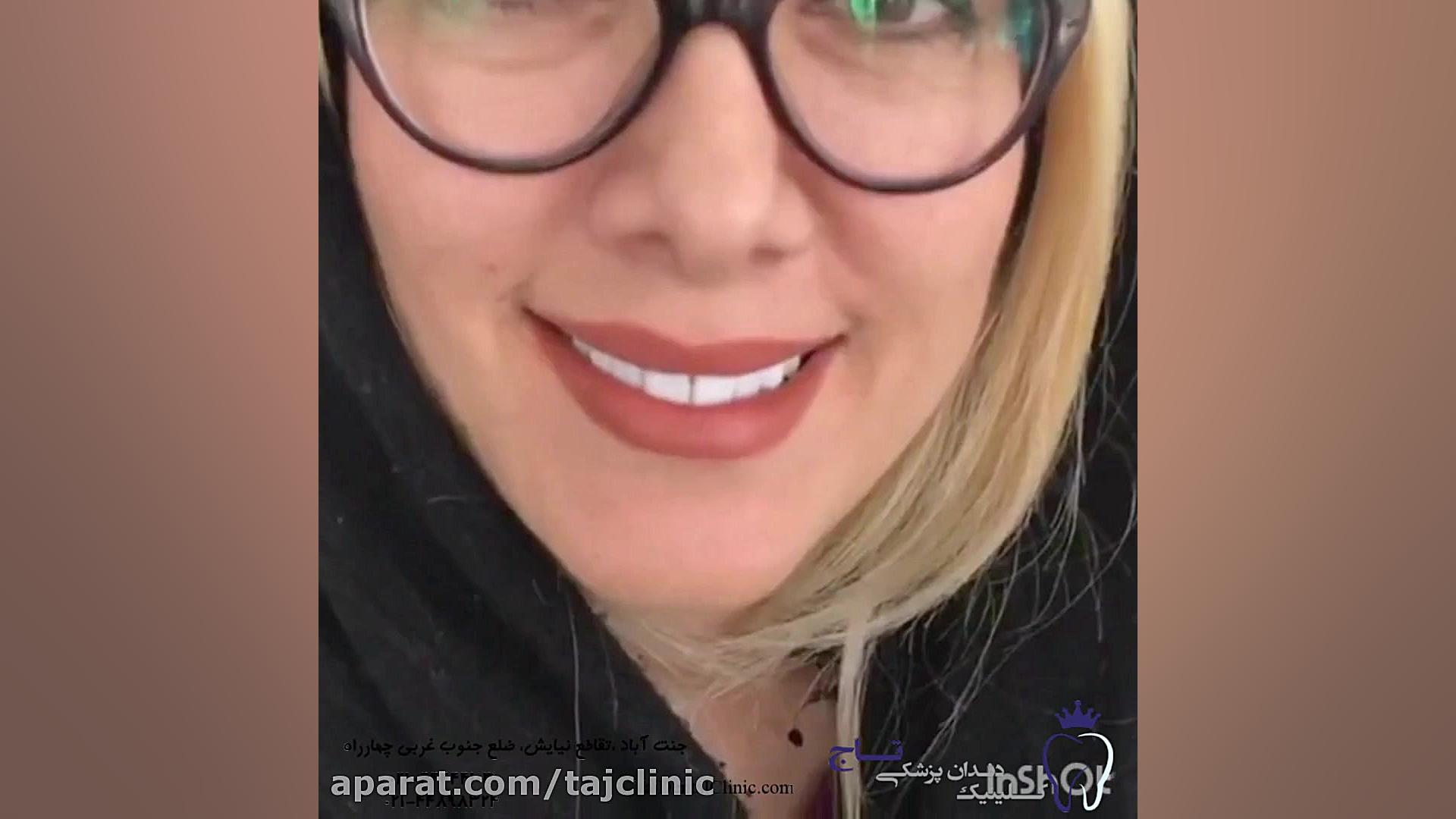 نمونه کامپوزیت ونیر تری‌متازیدین