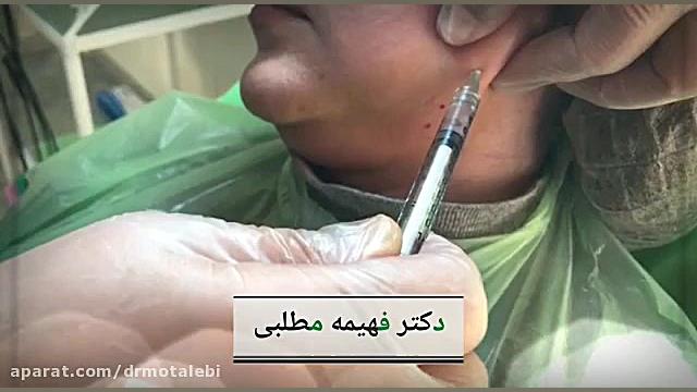 مزوتراپی غبغب دستگاه آنالیز اگزوزوم