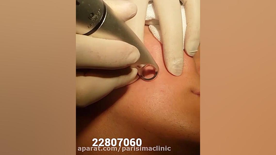 برداشت خال - کلینیک زیبایی پری سیما - 22807060 بررسی اروماتاز