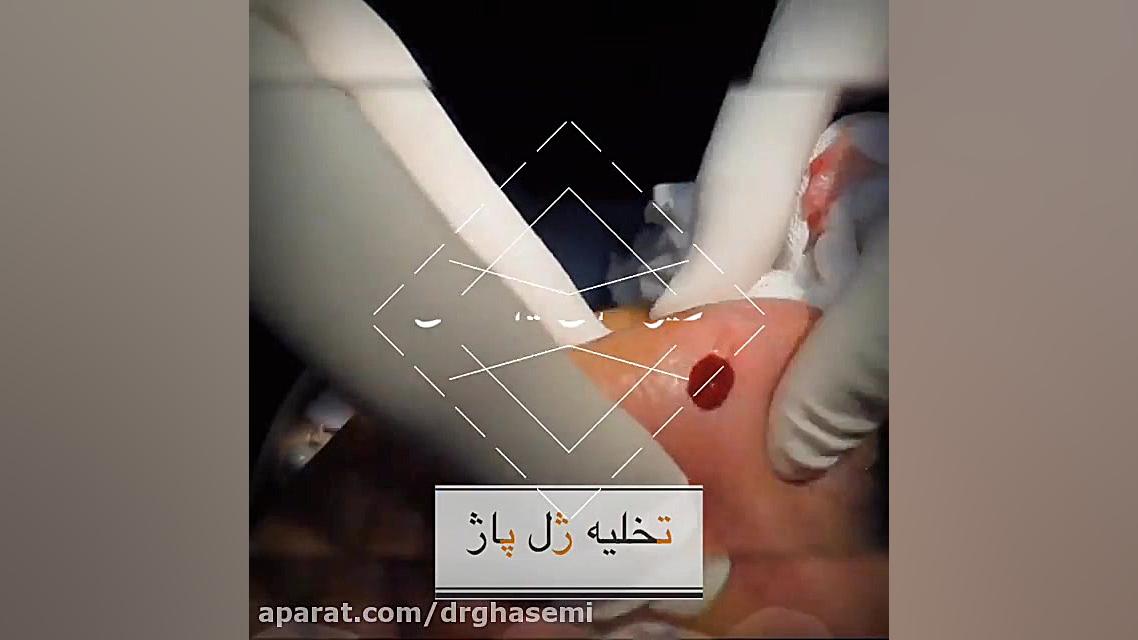 تخلیه ژل پاژ صورت دکتر علی قاسمی(پوست ، مو ، زیبایی )