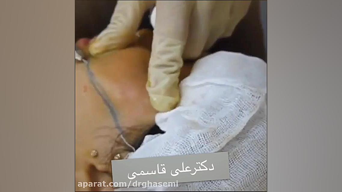 تزریق چربی به گونه دکتر علی قاسمی(پوست ، مو ، زیبایی )