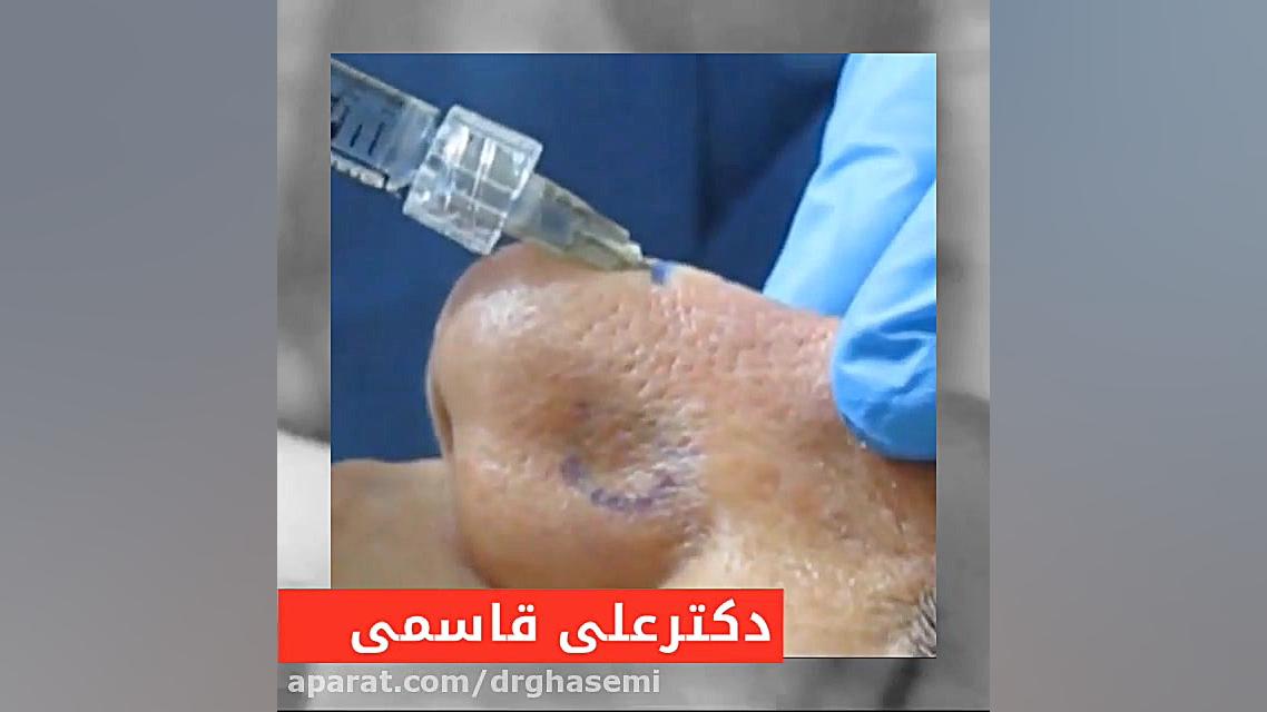 تزریق ژل به بینی دکتر علی قاسمی(پوست ، مو ، زیبایی )
