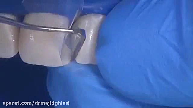 ترمیم پوسیدگی دندان-دکترمجیدقیاسی -دندانپزشک زیبایی سینتولاژوماب