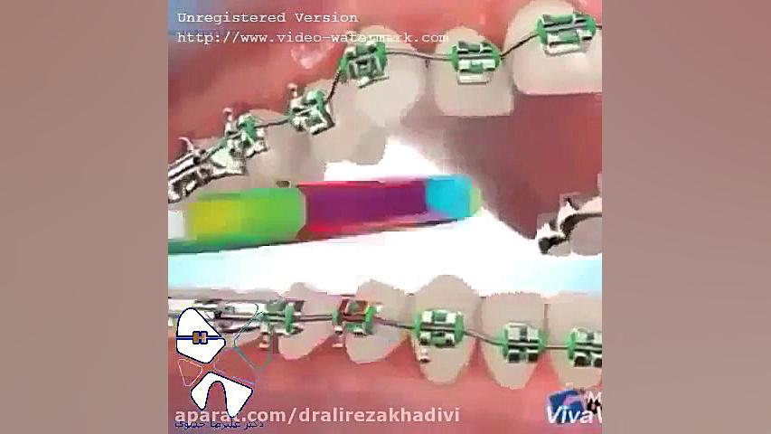 رژیم غذایی در هنگام ارتودنسی دکتر علیرضا خدیوی