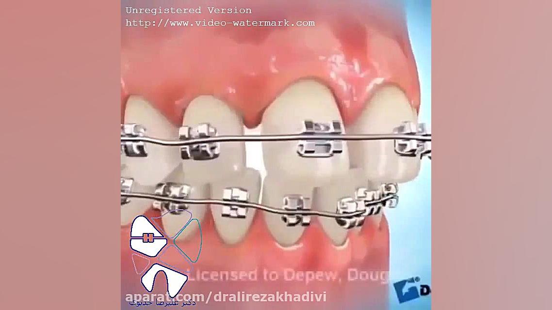 مرتب کردن فضای بین دندان ها دکتر علیرضا خدیوی