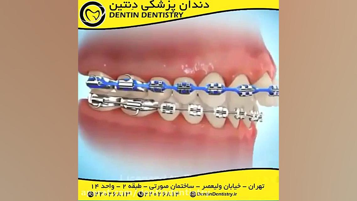 اثر ارتودنسی بر نا هنجاری های فک بالا و پایین دندانپزشکی دنتین دکتر محسن عابدلو