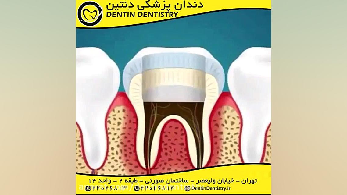 عصب کشی (روت کانال) RTC دستگاه Cell Sorter
