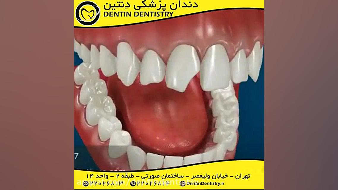 دندانپزشکی زیبایی دندانپزشکی دنتین دکتر محسن عابدلو