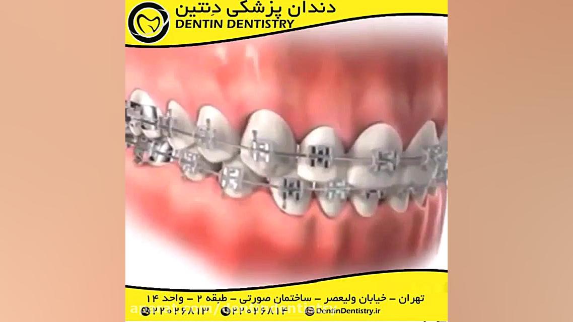 شیوه صحیح استفاده از مسواک و نخ دندان برای ارتودنسی دندانپزشکی دنتین دکتر محسن عابدلو