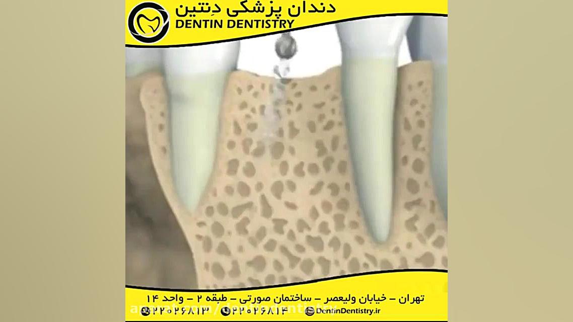 مراحل کاشت ایمپلنت دندانپزشکی دنتین دکتر محسن عابدلو