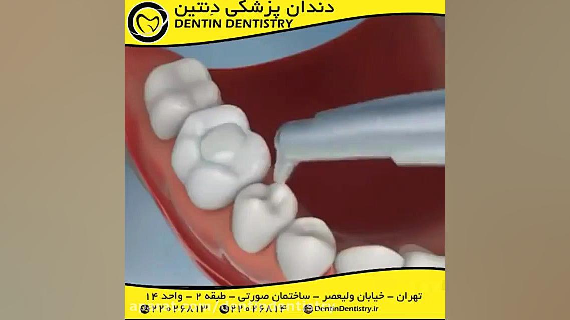 ترمیم پوسیدگی سطحی دندانپزشکی دنتین دکتر محسن عابدلو