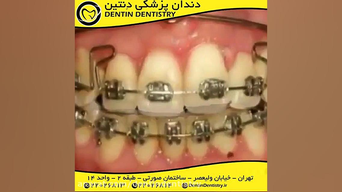 تأثیر ارتودنسی بر زیبایی چهره و لبخند شما دندانپزشکی دنتین دکتر محسن عابدلو