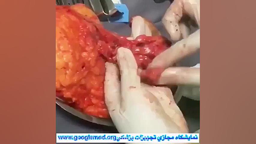 برداشتن پستان به صورت كامل (سرطان سینه) ارتودنسی