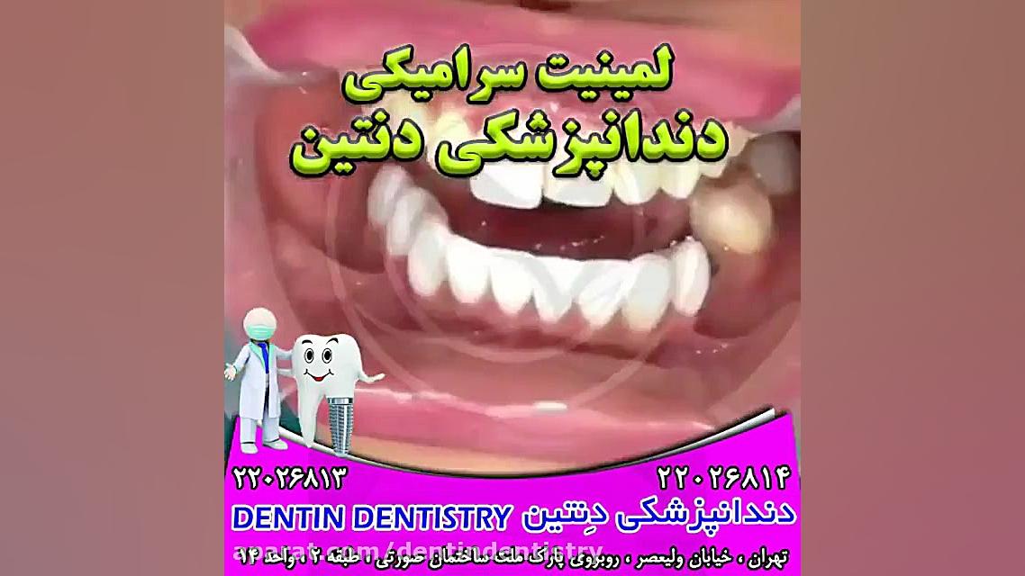 لمینت سرامیکی دندانپزشکی دنتین دکتر محسن عابدلو