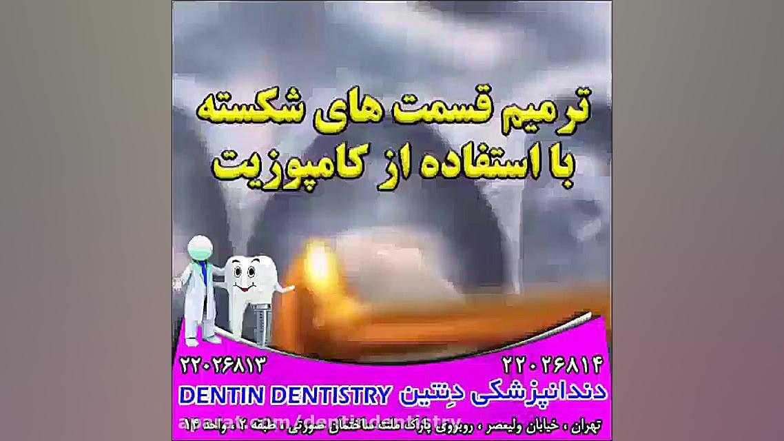 ترمیم قسمت های شکسته با کامپوزیت دندانپزشکی دنتین دکتر محسن عابدلو