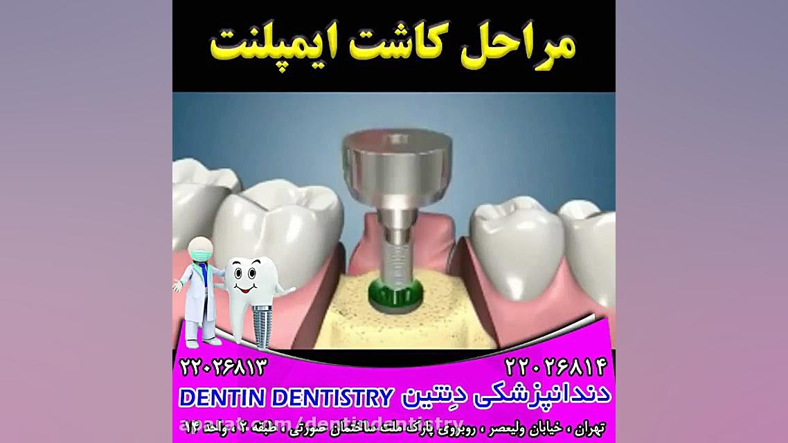 مراحل کاشت ایمپلنت دندانپزشکی دنتین دکتر محسن عابدلو