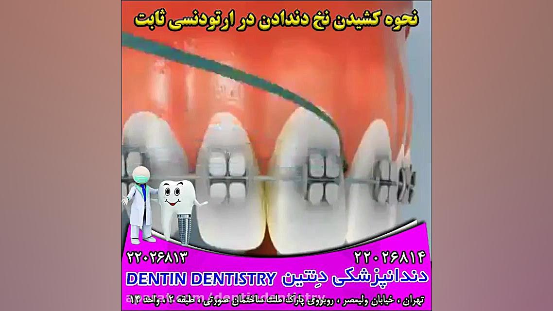 نحوه کشیدن نخ دندان در ارتودنسی ثابت دندانپزشکی دنتین دکتر محسن عابدلو