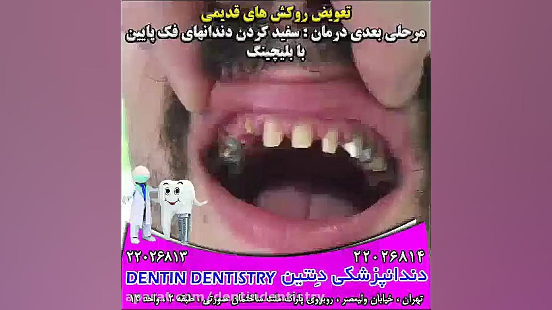 تعویض روکش های قدیمی دندانپزشکی دنتین دکتر محسن عابدلو
