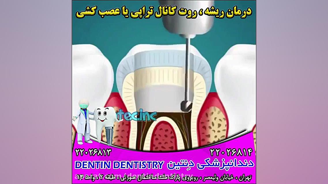 درمان ریشه ، روت کانال تراپی (عصب کشی) دندانپزشکی دنتین دکتر محسن عابدلو
