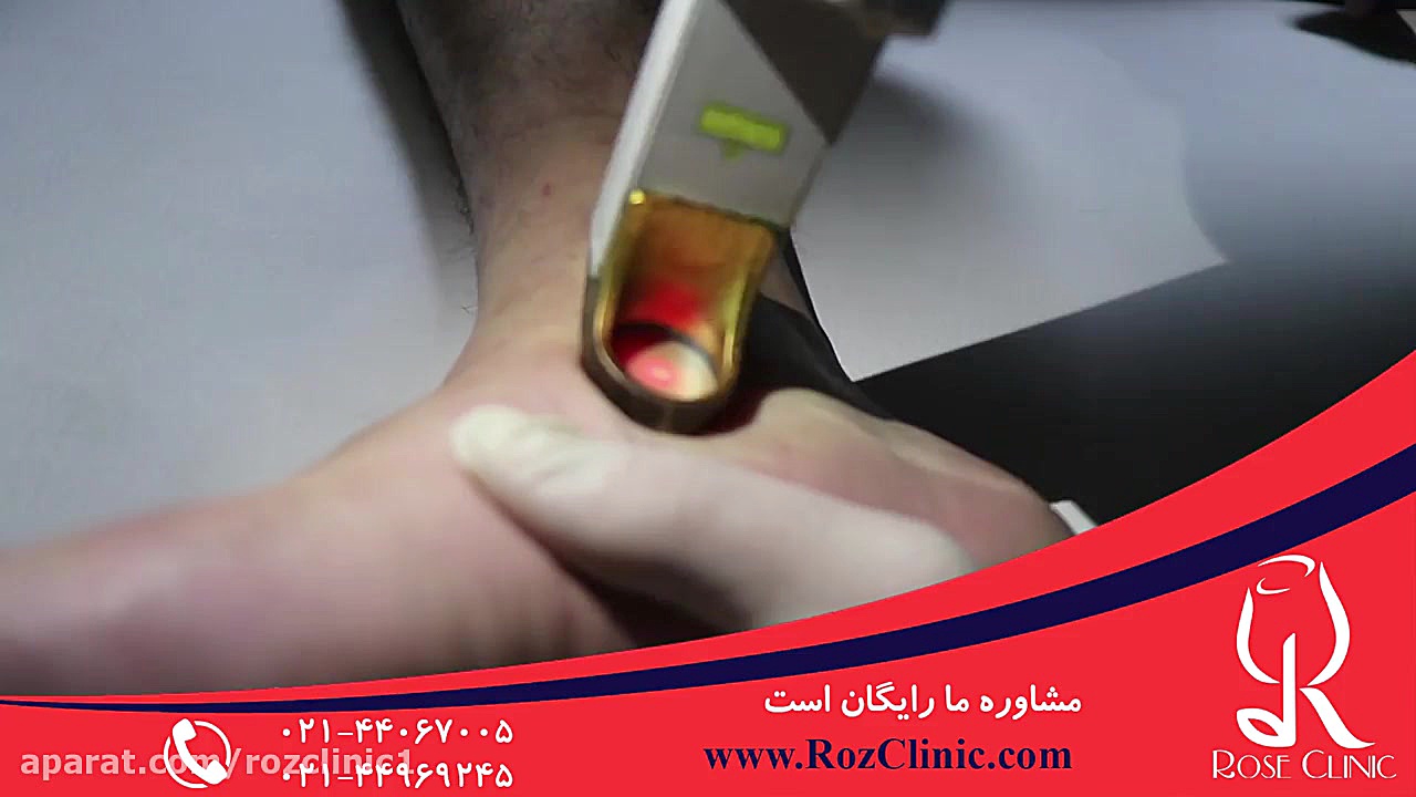 لیزر موهای زائد | لیزر مو | کلینیک پوست و مو رز | شماره10 پروتز دندان