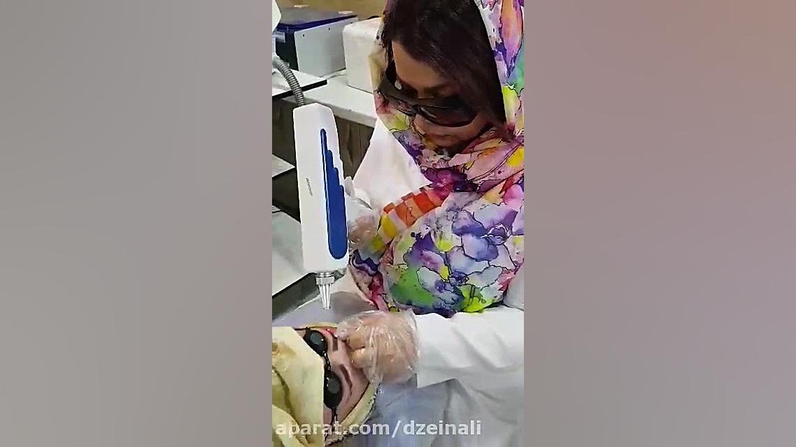 پاک کردن تاتوی ابرو و خالکوبی بدن دکتر فرحناز زینعلی - متخصص پوست، مو، زیبایی زنجان