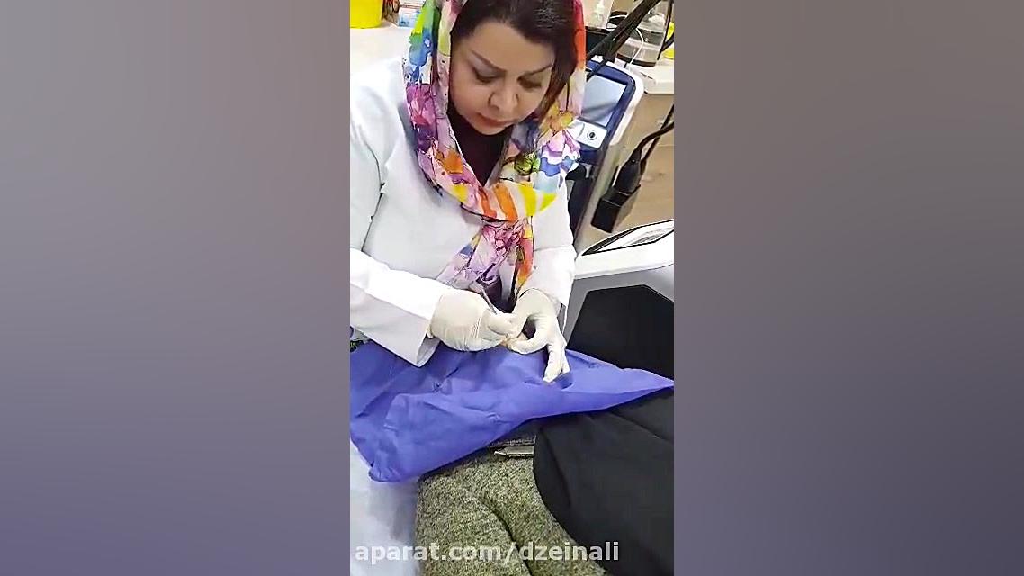جراحی خال های صورت بدون باقی ماندن جا و اسکار دکتر فرحناز زینعلی - متخصص پوست، مو، زیبایی زنجان