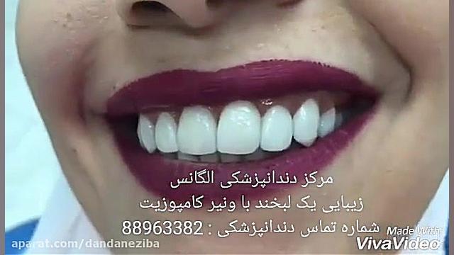 مراحل عصب کشی دندان | عصب کشی دندان بدون درد ChIP-Chip