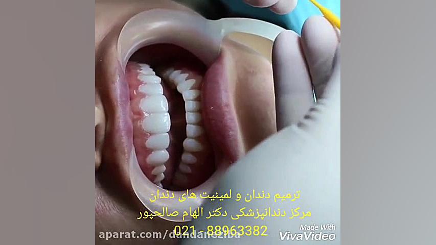 سفید کردن دندان | بلیچینگ دندان | کامپوزیت دندان | روکش دندان میوکلونوس
