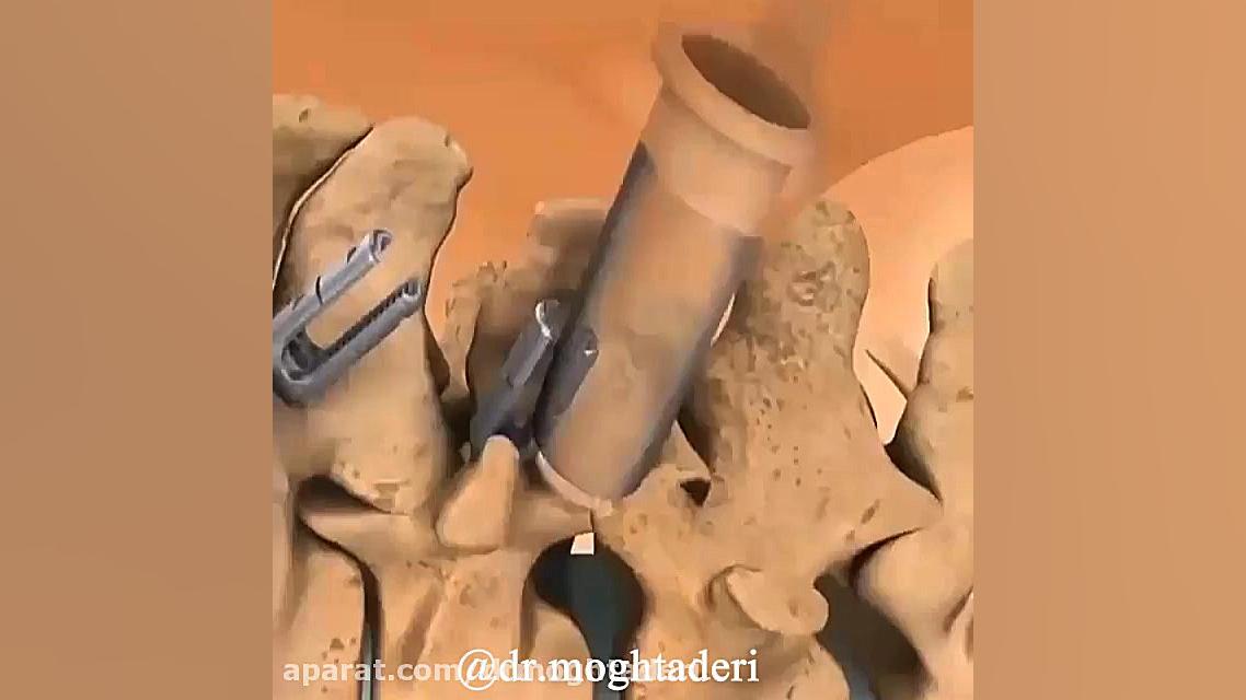 روش جراحی و رفع انحنای ستون فقرات دکتر علیرضا مقتدری | متخصص طب فیزیکی