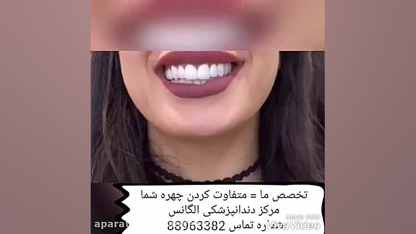 روش چسباندن ونیر کامپوزیت | روش چسباندن لمینیت سرامیکی دندان لیفت صورت