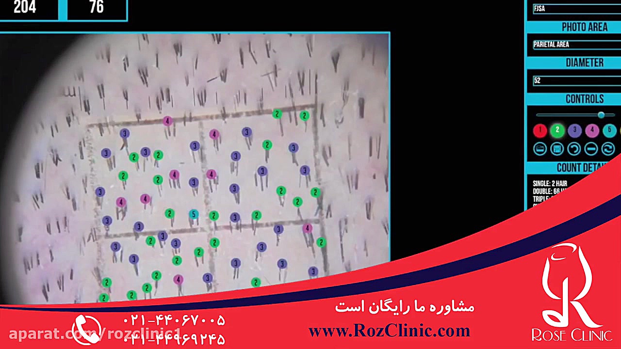 کاشت مو | فیلم کاشت مو | کلینیک پوست و مو رز | شماره15 میکرونیدلینگ