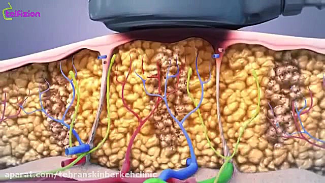 هایفوتراپی برای لاغری و آب کردن چربی اضافه در مرکز تخصصی برکه رفع غبغب