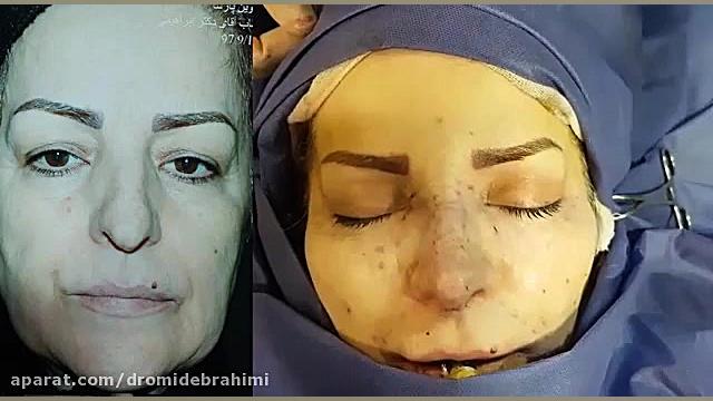 جراحی بینی استخوانی انحراف دار، توسط دکتر امید ابراهیمی دکتر امید ابراهیمی