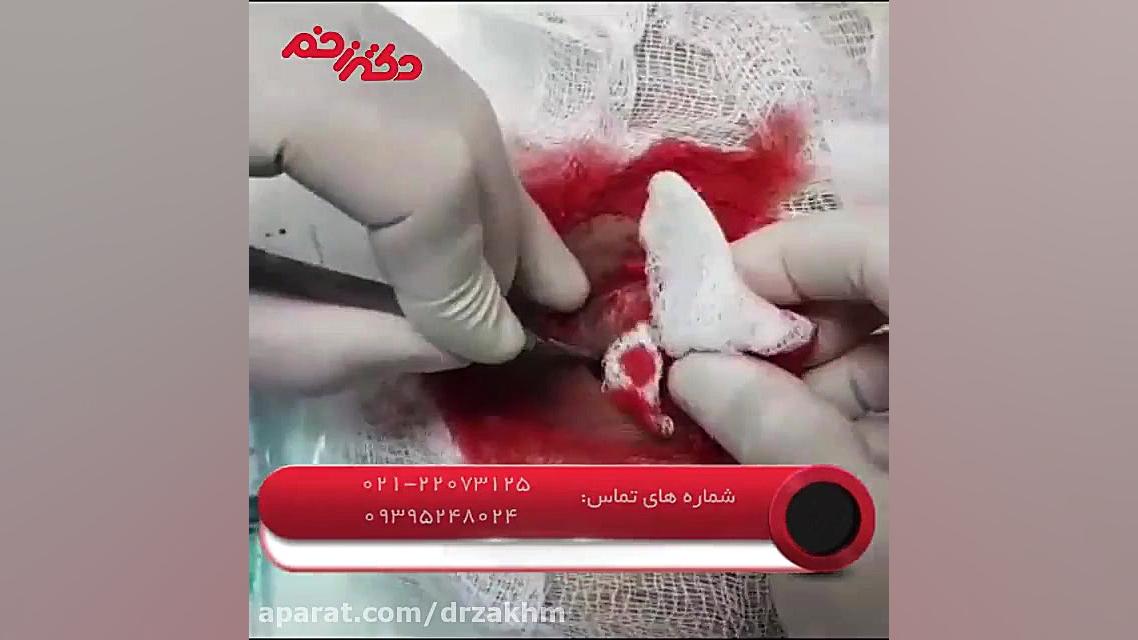 جراحی زخم پای دیابتی توسط تیم فوق تخصصی دکتر زخم Synaptic Vesicle Tracking