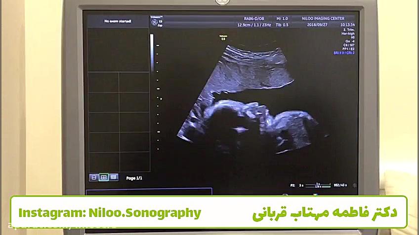 کاهش میزان مایع آمنیون در بارداری ترمیم ونیر