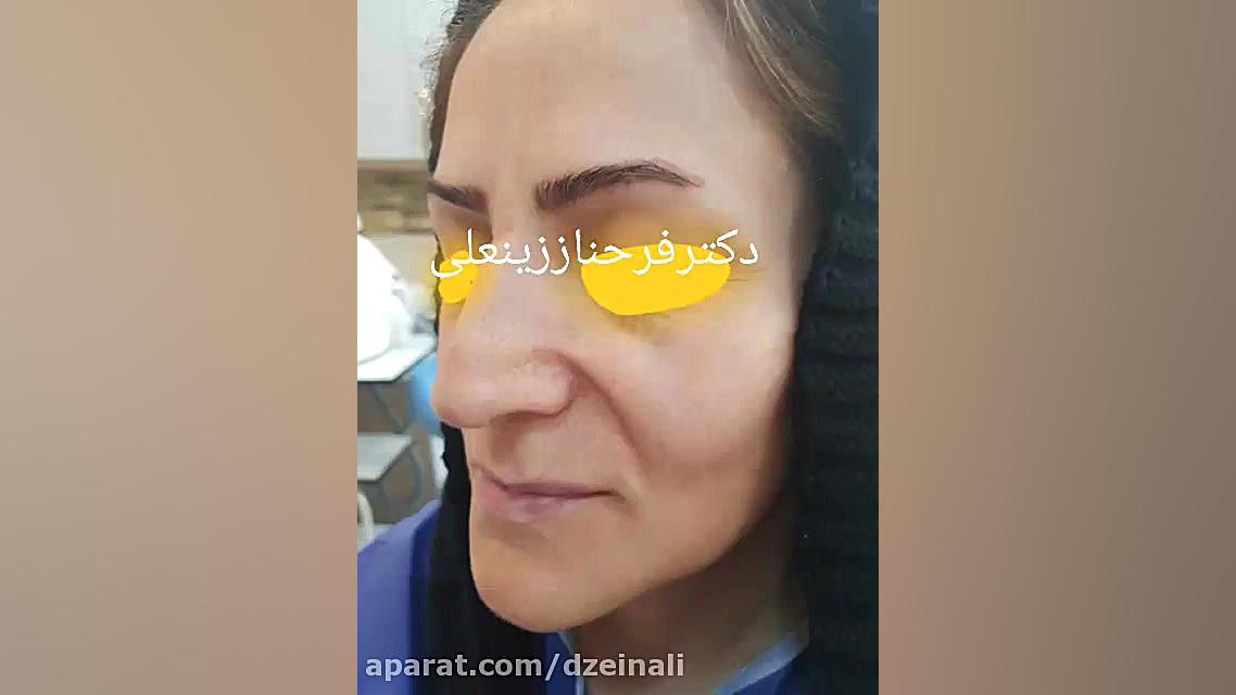 تزریق چربی از شکم به صورت و دست ها بازگشت جوانی و زیبایی دکتر فرحناز زینعلی - متخصص پوست، مو، زیبایی زنجان