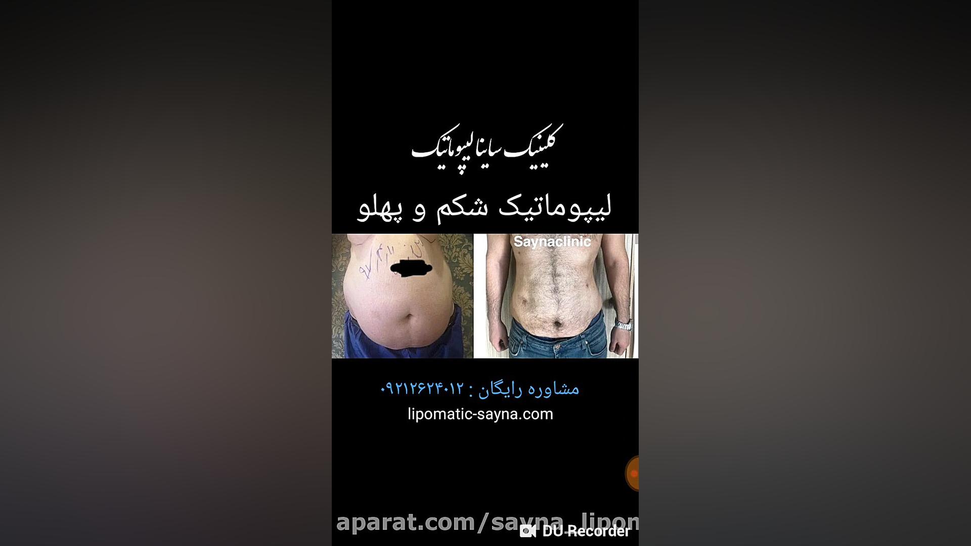 فیلم لیپوماتیک شکم و پهلو بیماری پیرفیریک نوروپاتی