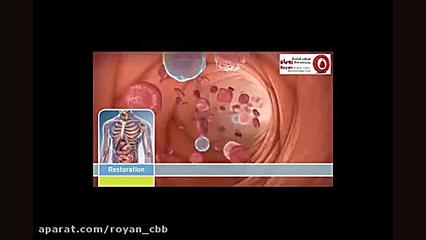 ذخیره سازی سلول های بنیادی خون محیطی قبل از شیمی درمانی پروتز سینه