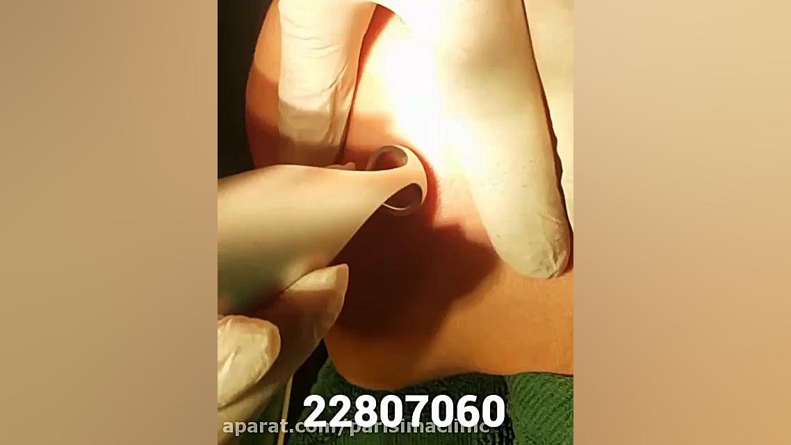 برداشت خال - کلینیک زیبایی پری سیما - 22807060 لکوپنی شدید