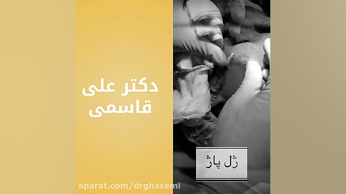 تخلیه ژل از گونه دکتر علی قاسمی(پوست ، مو ، زیبایی )