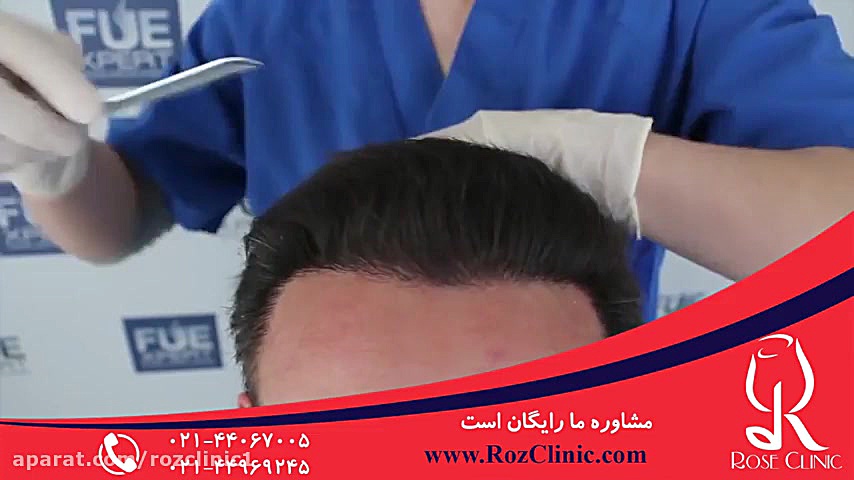 کاشت مو | فیلم کاشت مو | کلینیک پوست و مو رز | شماره17 NET-Seq