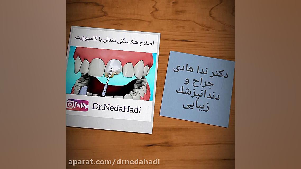 اصلاح شکستگی دندان با کامپوزیت دکتر ندا هادی-دندانپزشک زیبایی