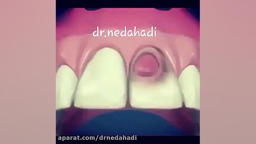 ایمپلنت دندان | دکتر ندا هادی دنداپزشک ترمیمی و زیبایی دکتر ندا هادی-دندانپزشک زیبایی