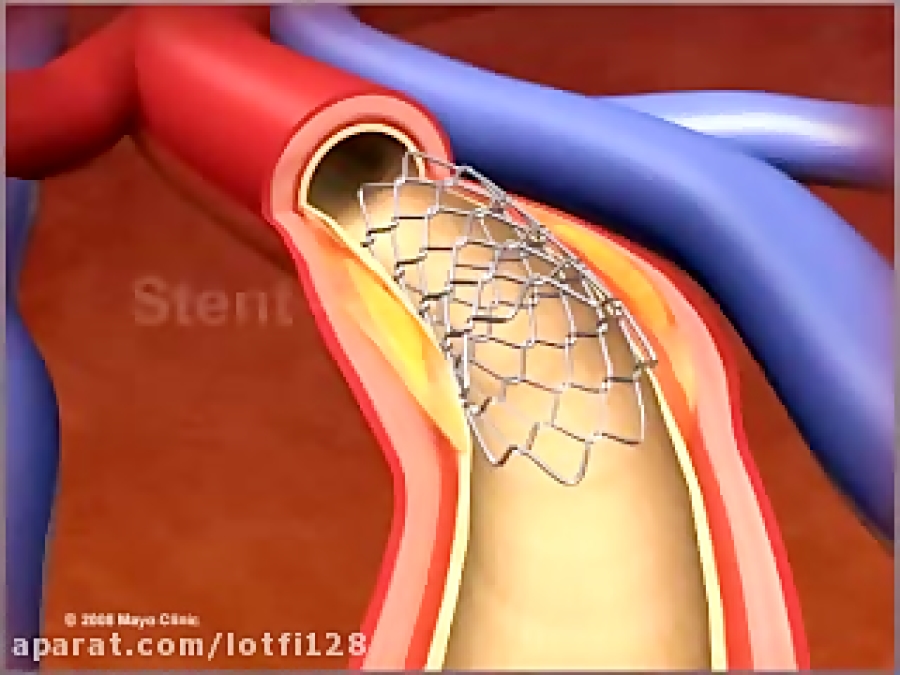 Операция стентирование. Стентирование через паховую артерию. Стентирование аорты сердца. Баллонное стентирование сердца. Стентирование сосудов сердца катетер.