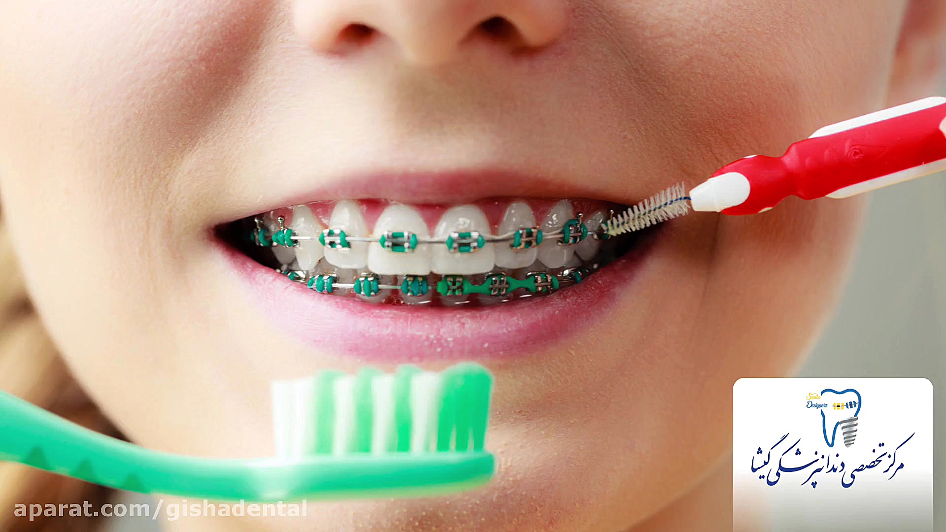 مزایا و معایب ارتودنسی ثابت کلینیک دندانپزشکی دکتر عزیز گشاده رو